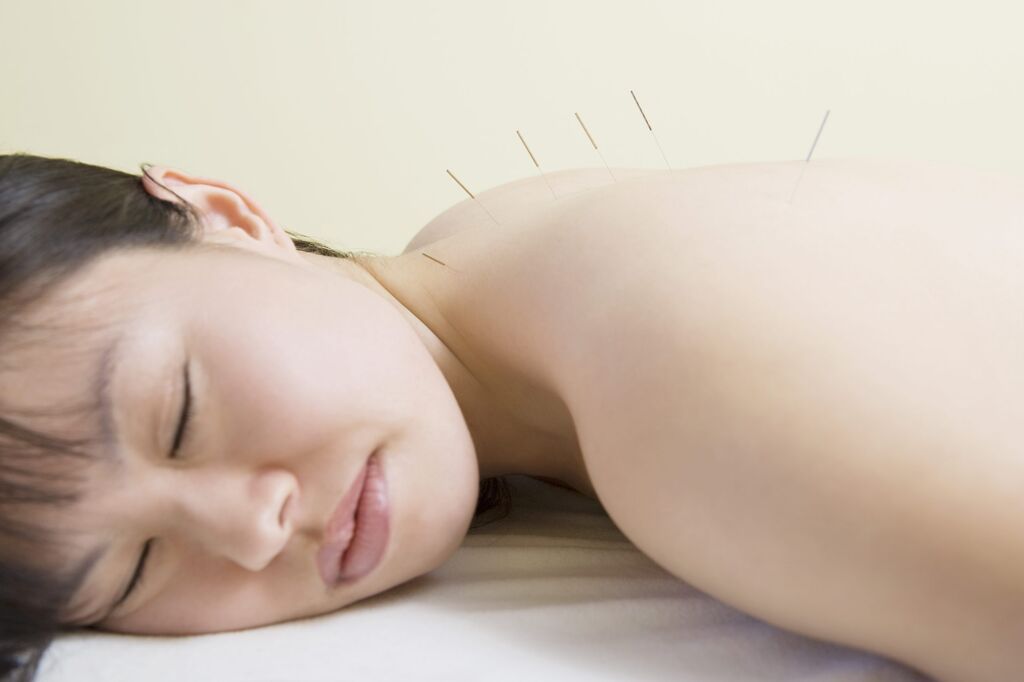 woman receiving acupuncture