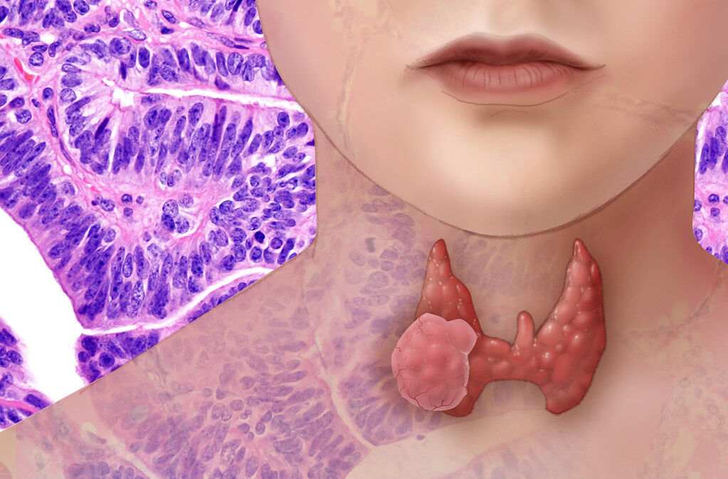 thyroid- graves', hypothyroid, and thyroid health solutions